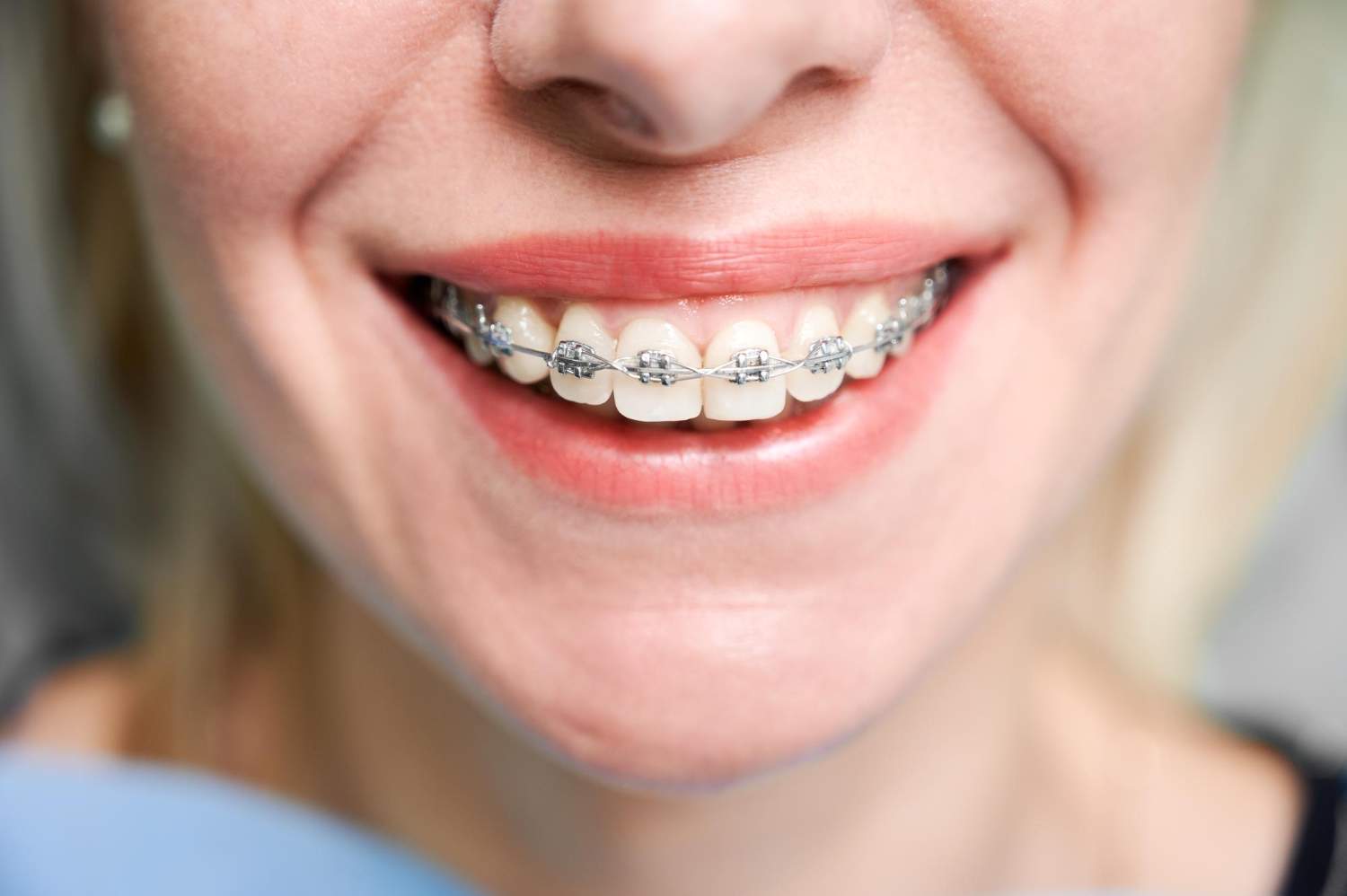 Brackets autoigualables