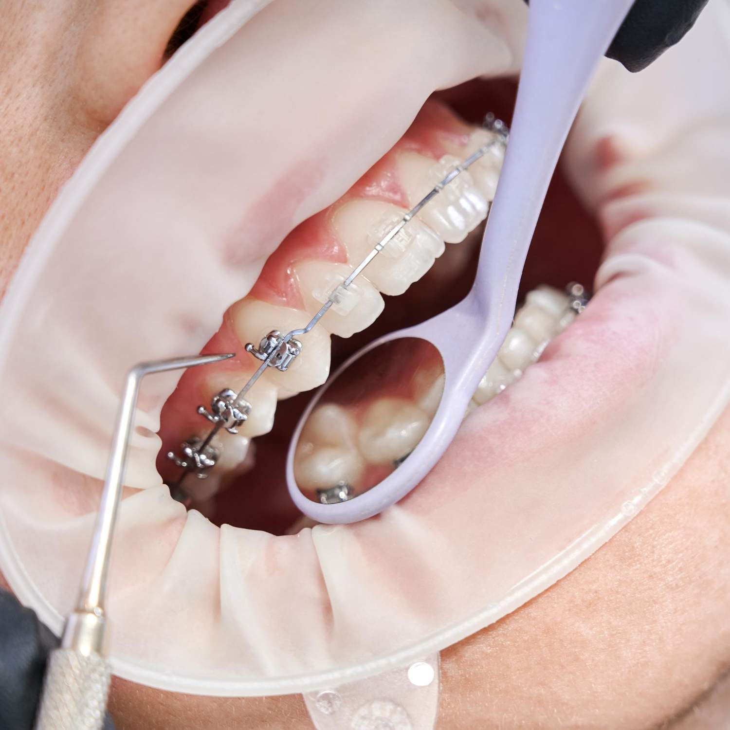 brackets esteticos