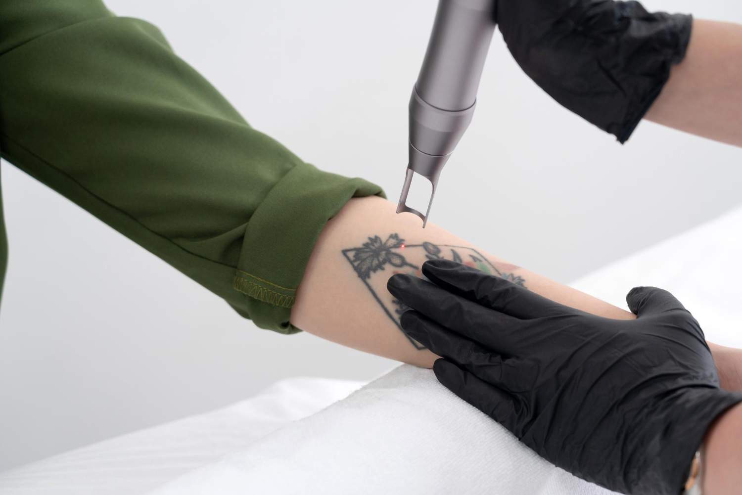 eliminacion tatto
