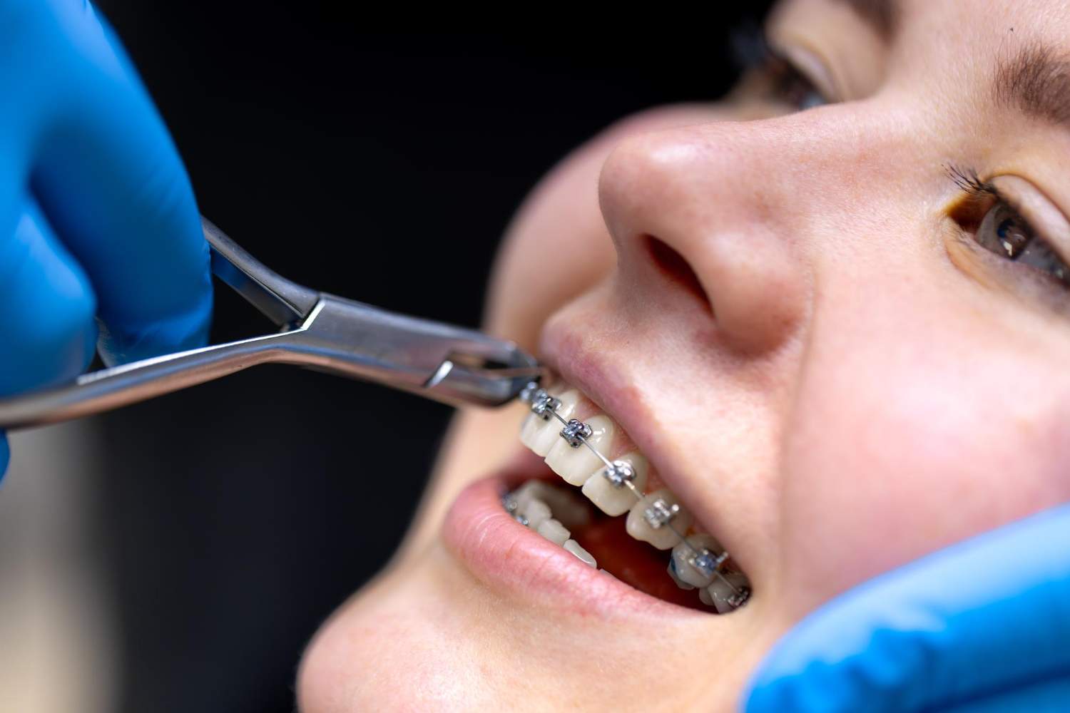 brackets metalicos